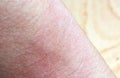 Allergic rash dermatitis eczema skin Royalty Free Stock Photo