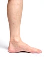 Allergic rash dermatitis eczema skin of patient legs Royalty Free Stock Photo