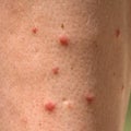 Allergic rash dermatitis leg skin Royalty Free Stock Photo