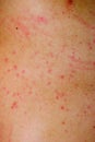 Allergic rash dermatitis skin