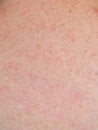 Allergic rash dermatitis skin Royalty Free Stock Photo