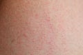 Allergic rash dermatitis skin