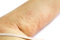 Allergic rash skin of patient arm Royalty Free Stock Photo