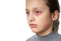 Allergic reaction, skin rash, close view portrait of a girl`s face. Redness and inflammation of the skin in the eyes and lips. Royalty Free Stock Photo