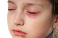 Allergic reaction, skin rash, close view portrait of a girl`s face. Redness and inflammation of the skin in the eyes and lips. Royalty Free Stock Photo