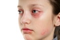 Allergic reaction, skin rash, close view portrait of a girl`s face. Redness and inflammation of the skin in the eyes and lips. Royalty Free Stock Photo