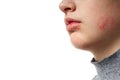 Allergic reaction, skin rash, close view portrait of a girl`s face. Redness and inflammation of the skin in the eyes and lips. Royalty Free Stock Photo