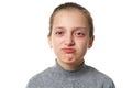 Allergic reaction, skin rash, close view portrait of a girl`s face. Redness and inflammation of the skin in the eyes and lips. Royalty Free Stock Photo