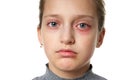 Allergic reaction, skin rash, close view portrait of a girl`s face. Redness and inflammation of the skin in the eyes and lips. Royalty Free Stock Photo