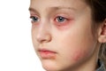 Allergic reaction, skin rash, close view portrait of a girl`s face. Redness and inflammation of the skin in the eyes and lips. Royalty Free Stock Photo