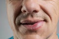 Allergic reaction on a man's lip after a bee sting Royalty Free Stock Photo