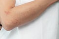 Allergic skin lesions on the arms Thailand Asian women.