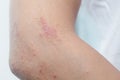 Allergic skin lesions on the arms Thailand Asian women.