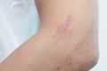 Allergic skin lesions on the arms Thailand Asian women.