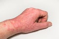 Allergic skin lesions of the hand with cracks, inflammation and flaking. Psoriasis, atopic dermatitis, eczema. Skin problems