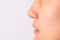 Allergic women have eczema dry nose and lips on winter season closeup. Royalty Free Stock Photo