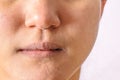 Allergic women have eczema dry nose and lips on winter season closeup. Royalty Free Stock Photo