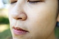 Allergic young woman have eczema dry nose on winter season,female people peeling skin with seborrheic dermatitis,atopic symptom on Royalty Free Stock Photo