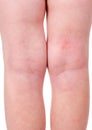 Allergies to the skin of a child on legs and knees of a disease on a white background