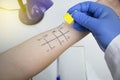 An allergist doctor in the laboratory conducts a prik allergy test. Skin test for household, food, epidermal allergic reactions