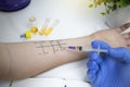 An allergist doctor in the laboratory conducts a prik allergy test. Skin test for household, food, epidermal allergic reactions