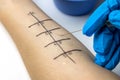 allergist doing skin prick allergy test on a patient arm Royalty Free Stock Photo