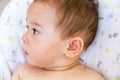 Allergy baby skin dermatitis food. child dermatitis symptom problem rash. face sleeping newborns. suffering atopic symptom on skin