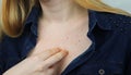 Allergy concept. Young woman with pimples on the chest, closeup