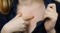 Allergy concept. Young woman with pimples on the chest, closeup