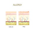 Allergy. healthy and skin with allergic reaction. Royalty Free Stock Photo