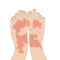 Allergy red rash on foot, flat illustration on white background