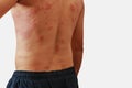 Allergy rash and Health problem. Royalty Free Stock Photo