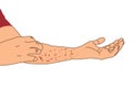 Allergy rash red on arm, itching from urticaria or atopic dermatitis, illustration on white background