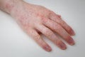 Allergy, red itchy rash on male hand on white table. Dermatological problem, skin symptom of patient. Close up shot