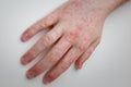 Allergy, red itchy rash on male hand on white table. Dermatological problem, skin symptom of patient. Close up shot