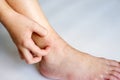 Allergy skin at ankle of an Asian kid with her hand to scratch. Royalty Free Stock Photo