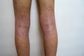 Allergy skin of an Asian kid on the back of her legs in natural light Royalty Free Stock Photo