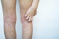 Allergy skin of an Asian kid on her legs with hand to scratch. Royalty Free Stock Photo