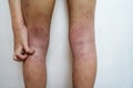 Allergy skin of an Asian kid on her legs with hand to scratch in natural light. Royalty Free Stock Photo