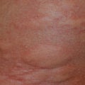 Allergy skin back and sides. Allergic reactions on the skin in the form of swelling and Royalty Free Stock Photo