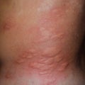 Allergy skin back and sides. Allergic reactions on the skin in the form of swelling and Royalty Free Stock Photo