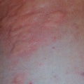 Allergy skin back and sides. Allergic reactions on the skin in the form of swelling and Royalty Free Stock Photo