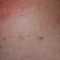 Allergy skin back and sides. Allergic reactions on the skin in the form of swelling and Royalty Free Stock Photo