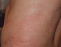 Allergy skin back and sides. Allergic reactions on the skin in the form of swelling and redness Royalty Free Stock Photo