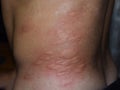 Allergy skin back and sides. Allergic reactions on the skin in the form of swelling and redness Royalty Free Stock Photo