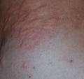 Allergy skin back and sides. Allergic reactions on the skin in the form of swelling and redness Royalty Free Stock Photo