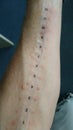 Allergy test on the forearm Royalty Free Stock Photo