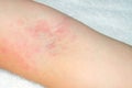 Allergy to red rash on the arms