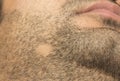 Alopecia Areata hair loss on cheek beard in a patch Royalty Free Stock Photo