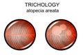 Alopecia areata. trichology